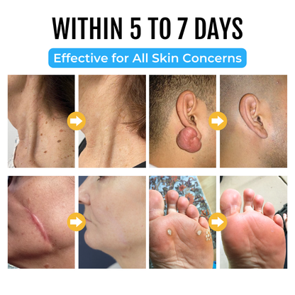 Biancat™ TagClear Moles & Warts Removal Serum